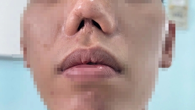 The boy had a deformed nose for 31 years and had to undergo many surgeries due to the consequences of his birth.