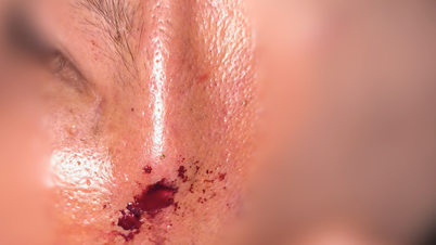 木の枝で皮膚にピアスを開けた男性が入院