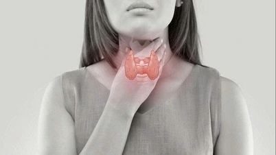 Nhân tuyến giáp: Có thực sự tan nhờ ăn uống và thảo dược?