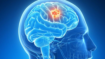 What is craniopharyngioma? When to see a doctor?