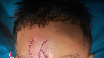Playing in front of the house, a 5-year-old boy was bitten by a German Shepherd, causing severe facial disfigurement.