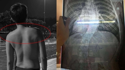 Office workers have severe shoulder dislocation and curved spine before the age of 30.