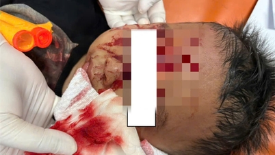 Boy bitten by German Shepherd, hospital mobilized 3 specialties for emergency surgery