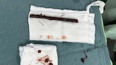 Rare case of a baby girl being pierced through the anus by a tree branch, remaining in the stomach for 4 months
