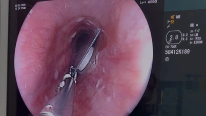 Quang Tri: Doctors promptly removed a pill with its zinc coating still intact that was lodged in a patient's esophagus.