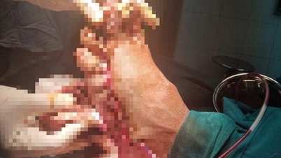 Man nearly loses his foot to lawnmower.