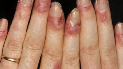 วิธีรักษาอาการมือเท้าชาจากความเย็นที่บ้านในช่วงฤดูหนาว