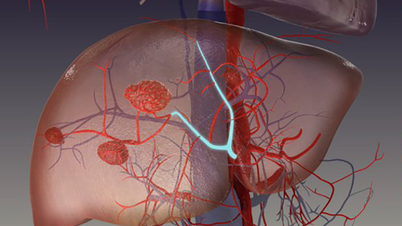Dolor en las costillas inferiores, falta de apetito, pérdida de peso… cuidado con el hemangioma hepático.