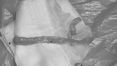 Un ver solitaire d'un mètre de long se tortillait dans les intestins d'un homme qui appréciait de manger du bœuf saignant.