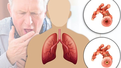 Người bệnh phổi tắc nghẽn mạn tính cần làm gì để khỏe hơn trong mùa lạnh?