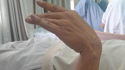 Pria berusia 37 tahun itu tertidur dengan kepala bersandar di lengannya, dan menderita kelumpuhan saraf radial.