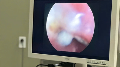 Ca Mau: Two children saved after swallowing dangerous foreign objects.