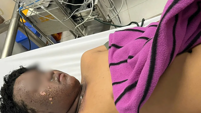 Vuurwerk dat online was gekocht, explodeerde en veroorzaakte ernstige brandwonden in het gezicht van een 13-jarige leerling.