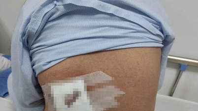 O femeie a dezvoltat necroză pe spate după ce a aplicat frunze de plante pentru a trata furuncule.