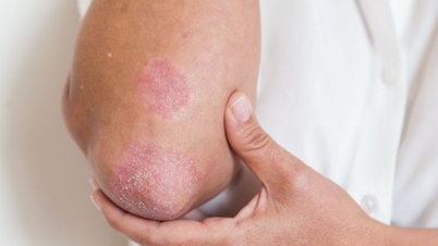 Rozpoznání příznaků psoriatické artritidy