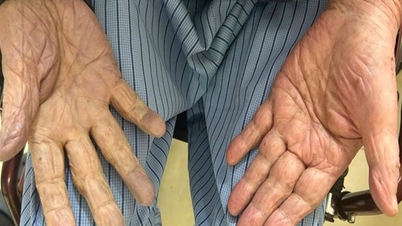 L'élimination de plusieurs caillots de sang a permis d'éviter l'amputation du bras d'un homme de 97 ans.