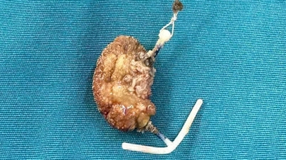 ينتقل جهاز داخل الرحم (IUD) إلى المثانة لمدة 22 عامًا.
