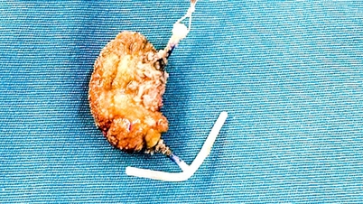 한 여성이 22년간 사용한 자궁내 피임기구(IUD)에서 결석이 방광으로 이동한 것을 성공적으로 제거했습니다.