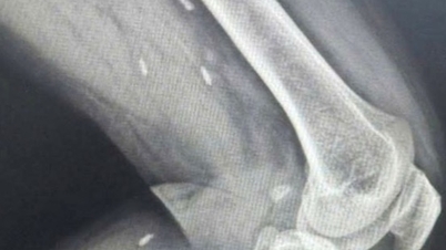 কোয়াং ত্রি প্রদেশের একজন রোগীর পায়ে পরজীবী কৃমির একাধিক সিস্ট ছিল।