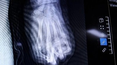 Mâna stângă a unui băiat de cincisprezece ani a fost zdrobită de explozia unei artificii.