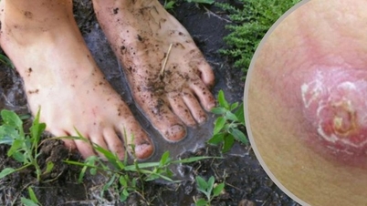 Vzácný absces varlete způsobený Whitmorovou chorobou: Varovný signál možné orchiektomie (odstranění varlete).