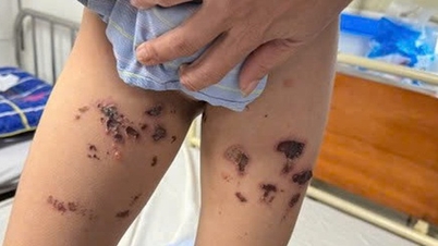 トイレ用洗剤が飛び散って男児が会陰部に重度の火傷を負う。