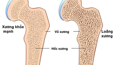 5 langkah untuk membantu memperkuat tulang dan mengurangi risiko osteoporosis.