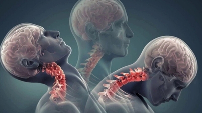 Many Vietnamese people's habits are "wearing down" their cervical spine.