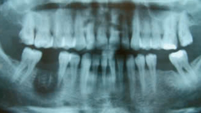 Care sunt riscurile utilizării arsenicului în tratamentul endodontic?