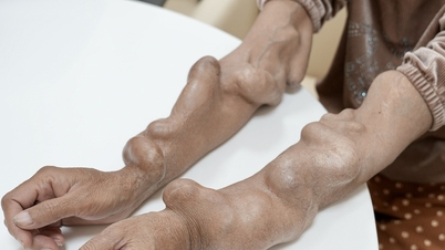 Behandeling van een patiënt die hemodialyse ondergaat en handmisvormingen heeft ontwikkeld als gevolg van spataderen.
