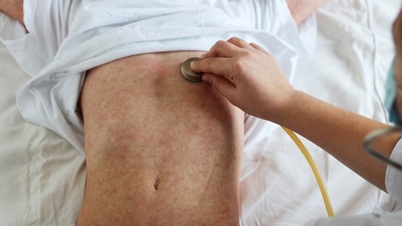 W związku ze zbliżającym się świętem Tet (Księżycowy Nowy Rok) należy zachować czujność w związku z epidemiami odry wśród dzieci.