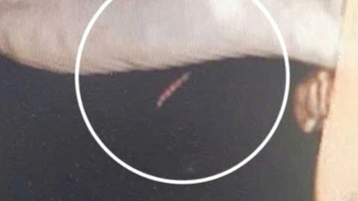 Surgery to remove a foreign object that had been "hiding" in the patient's chin for 10 days.