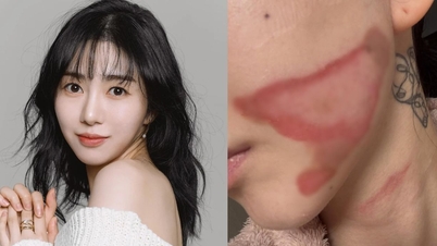 33세 가수는 성형수술 후 얼굴에 심한 화상을 입었다.
