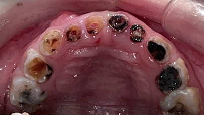 ¿La anestesia para procedimientos dentales consiste simplemente en “poner al paciente a dormir para que el procedimiento pueda realizarse más rápido”?