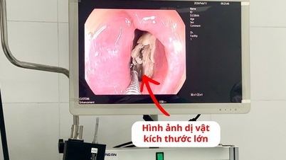 Îndepărtarea unui os mare de pui blocat în esofagul unui pacient.