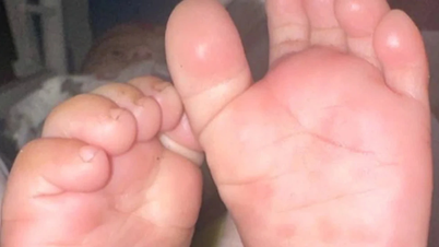 Budak lelaki berusia tiga tahun dijangkiti sifilis walaupun tidak menunjukkan sebarang gejala.