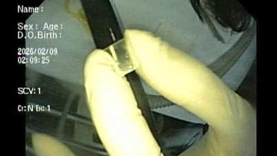 Bệnh viện Nhi Hải Phòng xử trí ca bệnh 10 tháng tuổi nuốt tấm kính nhựa