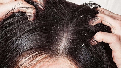 Seborrhoische Dermatitis der Kopfhaut verursacht übermäßige Schuppenbildung, die zu Wiederauftreten neigt und lange anhalten kann.