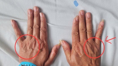 Küçük parmakta uzun süren uyuşma, eldeki kasların neredeyse erimesine neden olacaktı.