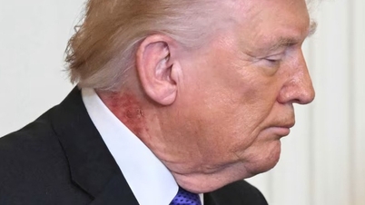 De arts van het Witte Huis spreekt zich uit over een vreemde rode vlek in de nek van president Trump.