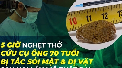 Пятичасовая напряженная спасательная операция позволила спасти 70-летнего мужчину, страдающего от камней в желчном пузыре и инородных тел, после двух неудачных операций.