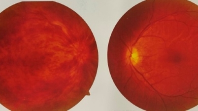 Warning about the risk of blindness from central retinal vein occlusion.