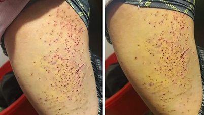 Lors d'une dispute concernant une place assise, une élève de 7e année a poignardé à plusieurs reprises une camarade de classe à la cuisse avec un stylo à bille.