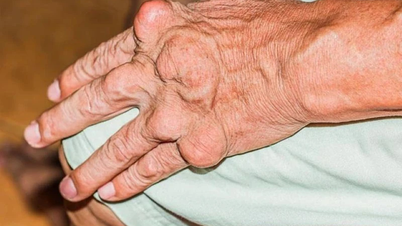 Fehler, die Gichtpatienten während der Behandlung begehen, können den Zustand verschlimmern.