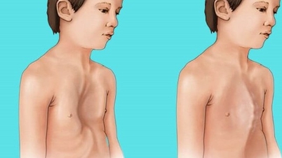 Um jovem de 18 anos tem síndrome de Marfan com complicações cardiovasculares perigosas; médicos alertam sobre os sinais de alerta precoce.
