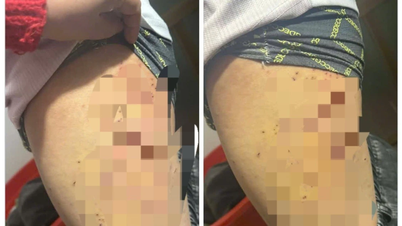 Egy hetedik osztályos lányt egy osztálytársa többször golyóstollal szúrt meg a combján.