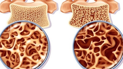 Yaşlı yetişkinlerin osteoporoz riskini azaltmalarına yardımcı olacak 4 ipucu.