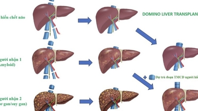 Vietnam genomför sin första dominoliknande organtransplantation.