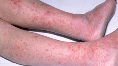 Implement measures to prevent meningococcal meningitis.
