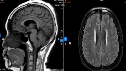 Žena trpěla přetrvávajícími bolestmi hlavy a objevila u sebe málo povšimnutý neurologický problém.